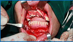 Implant placement in upper jaw after bone grafting with excess bone from lower jaw