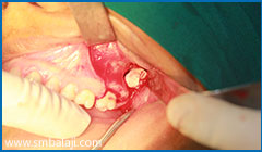 Left tooth surgically exposed