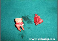 Removed infected tooth and cyst