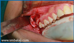 Right tooth surgically exposed