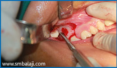 Right tooth surgically exposed