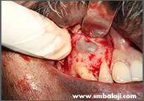 Surgical exposure of cyst