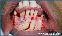 Surgical exposure of impacted teeth