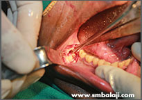 Surgical exposure of impacted tooth
