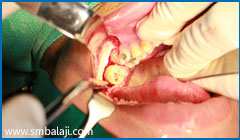 Surgical exposure of lower left impacted teeth
