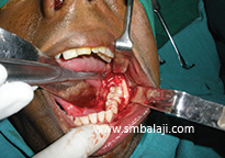 Surgical exposure of the impacted tooth and cyst