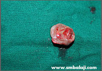 The excised cyst pathology
