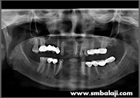 X-ray following surgery showing good bone healing