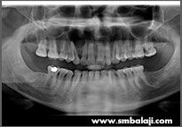 X-ray showing cyst lesion in upper jaw right side 