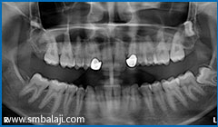X-ray showing impacted upper right and left third molar teeth