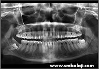 X-ray showing right lower impacted tooth with cyst lesion and other multiple impacted teeth