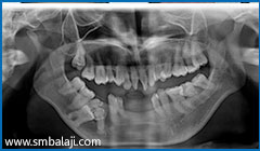 X-ray showing teeth impacted in the lower right jaw region