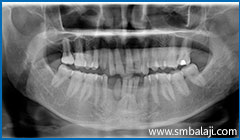 X-ray showing two impacted lower canine teeth