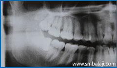 X-ray taken before extraction of upper right third molar tooth