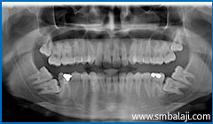 X-ray showing 6 impacted teeth- upper right and left third molars and lower right and left third and second molars