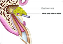 Infection and root tip removed in apicoectomy procedure