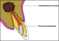 Severe infection at the root tip