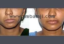 After distractor device is removed, successful completion of distraction to treat face asymmetry