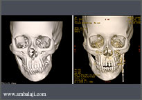 Consolidation period- active distraction is stopped and bone is allowed to mature -comparision of CT scans before and after treatment