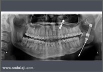 Distraction period- distractor pushing the cut bone segments apart creating new bone in between