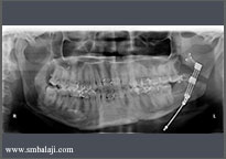 Distraction period- distractor pushing the cut bone segments apart creating new bone in between