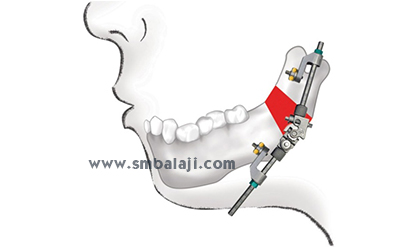 Mandibular external pin retained multivector distractor placed in lower jaw