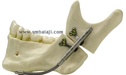 Mandibular univector internal distractor with rigid and flexible activation arms fixed to lower jaw bone.