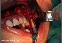 Osteotomy- Bone cut and distractor device fixed