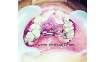 Palatal distractor placed to treat contsricted upper jaw