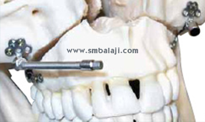 Right and left maxillary internal distractors with flexible activation arms placed inside the mouth.