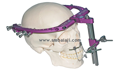 Rigid External Distractor (RED) fixed to the skull bones.