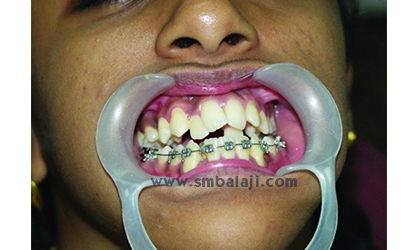 Using distraction, upper jaw expanded correcting crossbite