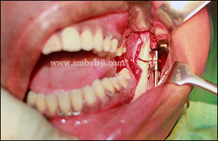 During surgical procedure, distractor device fixed to the outer surface of the ramus with correct orientation with the jaw