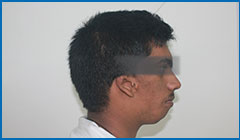  Ear deformity in patient with hemifacial microsomia
