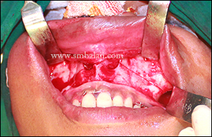 Lefort I osteotomy cut was placed in the maxilla and fixed to the mandible by IMF for simultaneous distraction