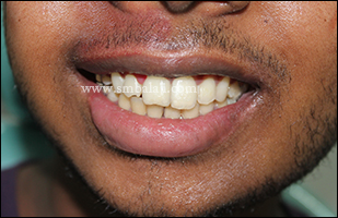 Postoperative view showing corrected occlusal cant by lengthening the lower half of the face using distraction osteohistogenesis
