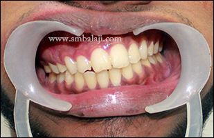 Preoperative bite showing occlusal cant due to reduced mandible height on the left side