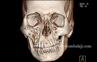 Preoperative 3D CT scan showing altered height of the ramus of the mandible on the left side leading to asymmetry