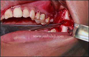 Trial activation done to check the movement of the mandible