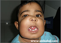 Patient at 18 months of age with tumour in upper and lower jaw