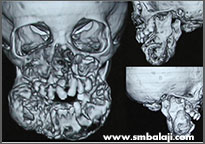 CT scan image showing tumour in upper and lower jaw