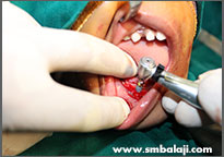 Implants being placed in the lower jaw