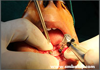 Implants being placed in the lower jaw