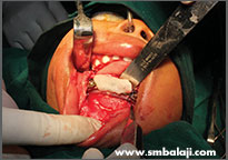 Jaw reconstruction using bone graft and rhBMP-2