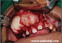 Removal of the tumour from the upper jaw