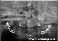 X-ray before implant surgery, showing good healing and recovery