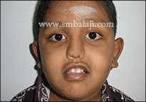 After successful  nose reconstruction
