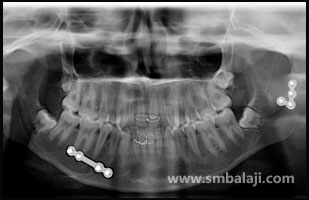 After surgery, X-ray showing fixation of fracture fragments