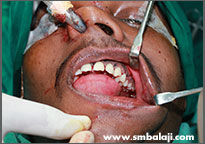 Avulsed teeth inserted in their respective sockets