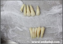 Avulsed teeth that were brought along with the patient after he met with a vehicular accident